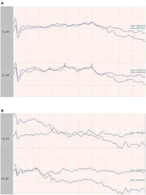 Neurophysiological Aspects in SARS-CoV-2–Induced Acute Respiratory Distress Syndrome